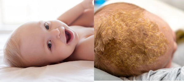 Cradle Cap vs Dry Skin